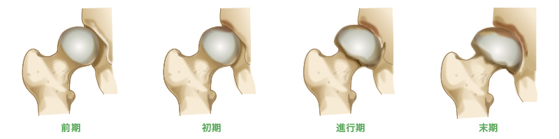 変形性股関節症の進行