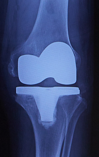 人工膝関節置換後のレントゲン