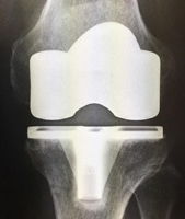 人工膝関節置換術のレントゲン