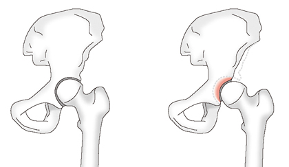 正常な股関節（左）と臼蓋形成不全（右）