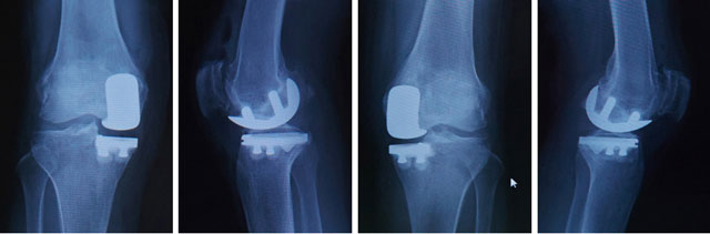 手術後のレントゲン写真（両側人工膝関節部分置換術）
