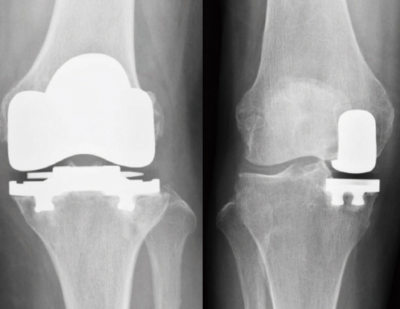人工膝関節全置換術（左）と
部分置換術（右）