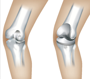 人工膝関節置換術（部分と全置換術）
