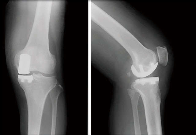 人工膝関節部分置換術後のレントゲン