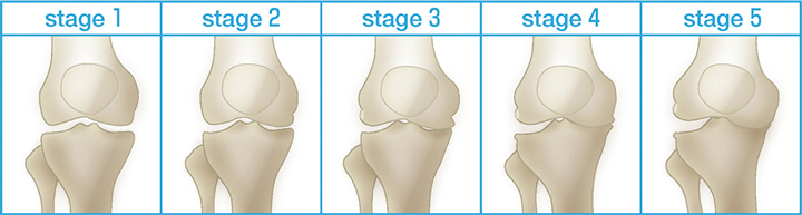 変形性ひざ関節症の5段階分類