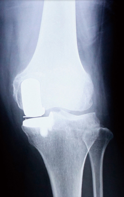 人工膝関節単顆型置換術後のレントゲン