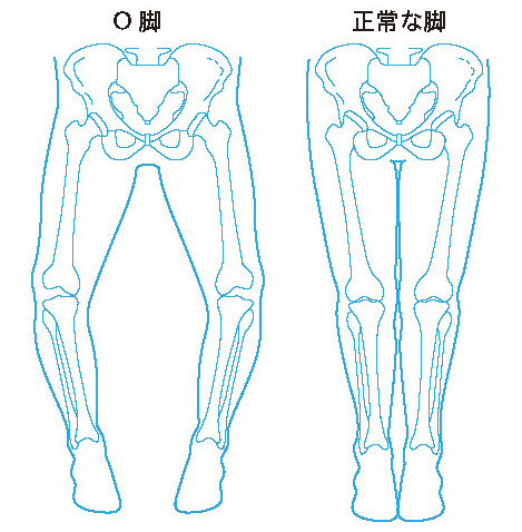 O脚と正常な脚