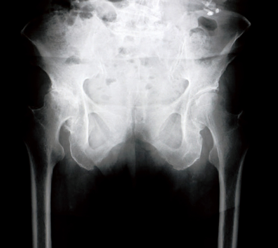 変形性膝関節症と変形性股関節症のレントゲン2