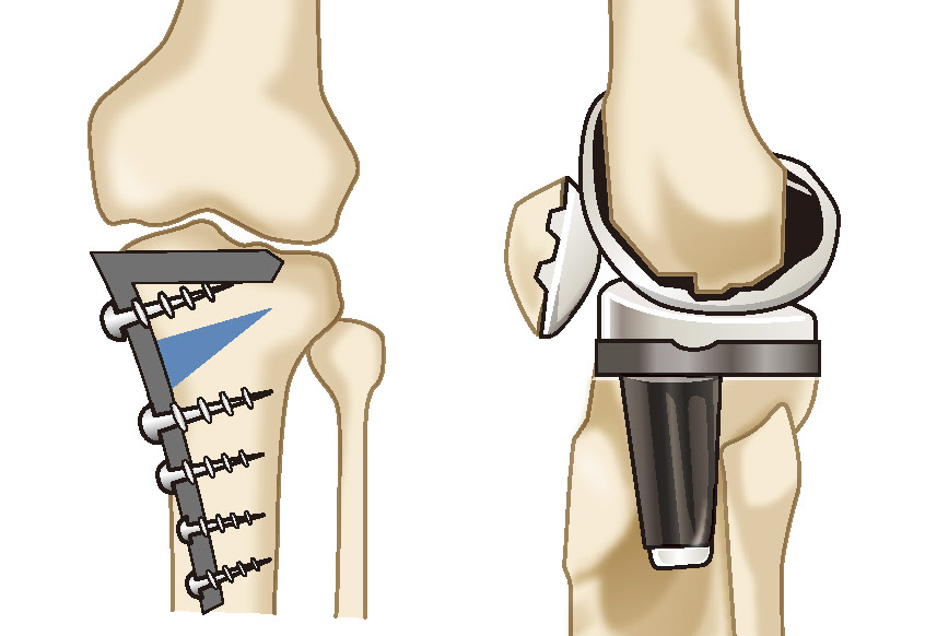 骨切り術と人工膝関節置換術