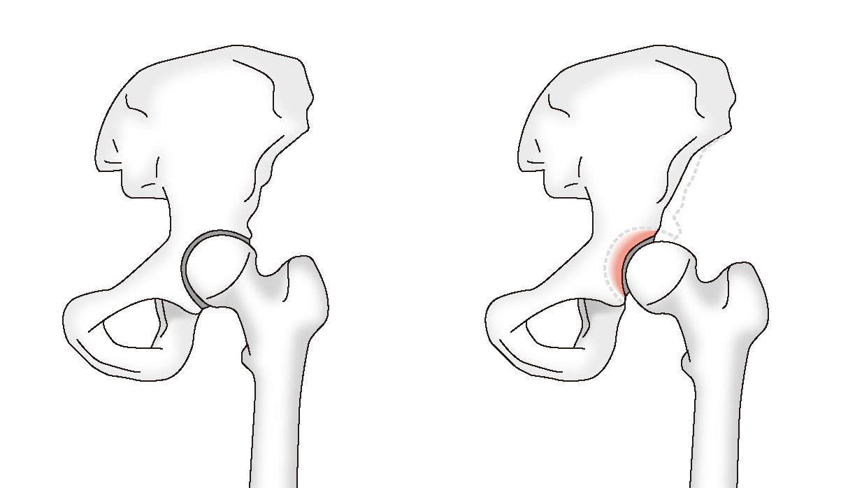 正常な股関節（左）と寛骨臼形成不全（右）