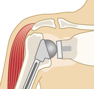 従来型の人工肩関節