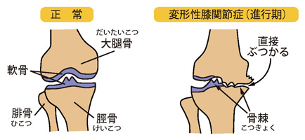 正常な関節と変形性膝関節症（進行期）