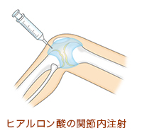 運動療法について