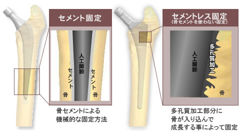 固定方法