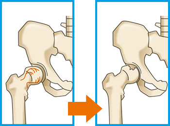 骨頭壊死 こっとうえし 原因となる病気 股関節の痛み 関節の痛み 人工関節ドットコム