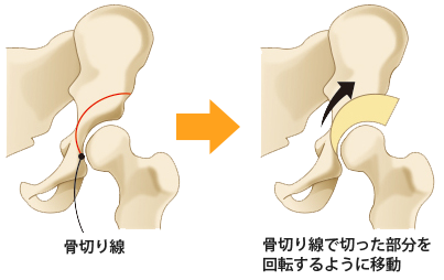 性 初期 壊死 症状 症 骨頭 大 特発 特発性大腿骨頭壊死症の検査・治療－人工関節、骨切り術などの適応や最新治療