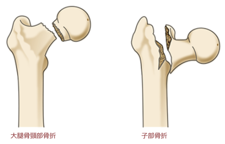 外傷 原因となる病気 股関節の痛み 関節の痛み 人工関節ドットコム