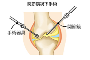 手術療法 変形性ひざ関節症 Oa 治療法 治療法 ひざ関節の痛み 関節の痛み 人工関節ドットコム