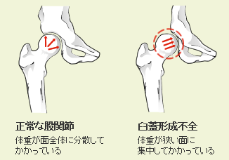 臼蓋形成不全