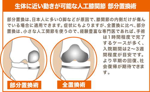 人口膝関節部分置換術