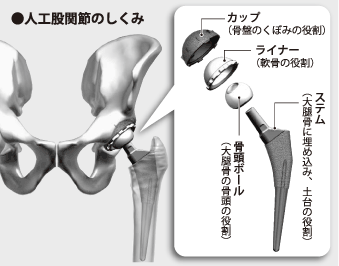 人工股関節のしくみ