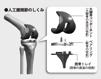 人工膝関節のしくみ