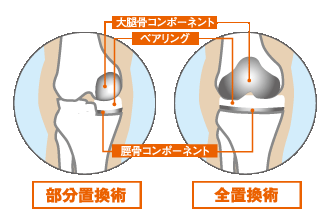 人工膝関節・置換術の種類
