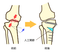 高位脛骨骨切り術(HTO)