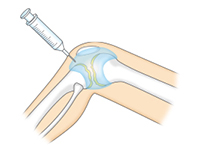 ヒアルロン酸注射