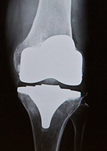 人工膝関節置換術後のレントゲン
