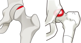 股関節唇損傷（左）とインピンジメント（右）