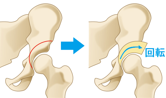 寛骨臼回転骨切り術