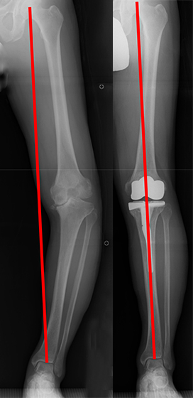 人工膝関節により脚の全体的なバランスが整う