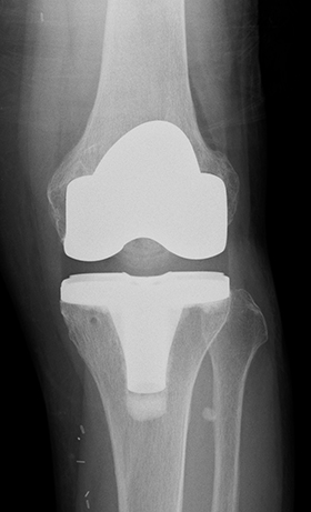 人工膝関節置換術後のレントゲン