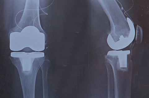 人工膝関節置換術後のＸ線