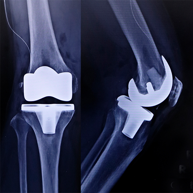 人工膝関節全置換術後のX線（正面と側面）