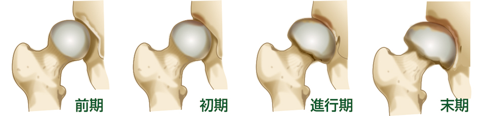 変形性股関節症の進行