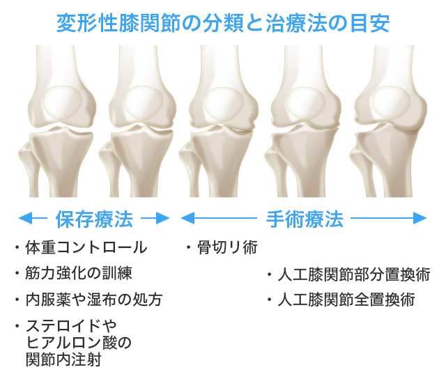 人工膝関節により脚の全体的なバランスが整う
