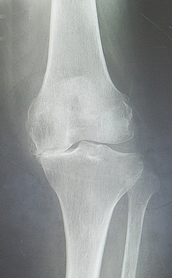 変形性膝関節症のX線
