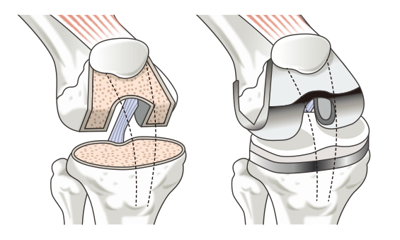 人工膝関節置換術