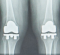 人工膝関節全置換術後のＸ線（両側）v