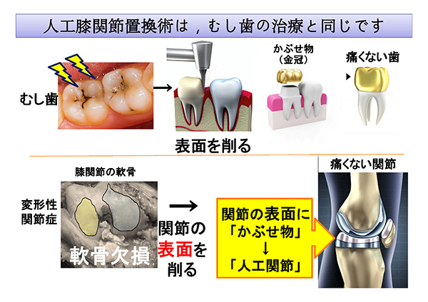 変形性膝関節症の治療は虫歯の場合と同じ