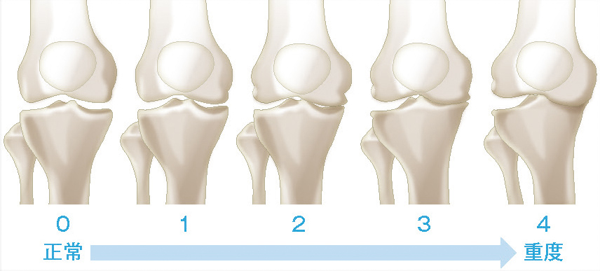 変形性膝関節症の分類