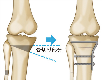 骨切り術