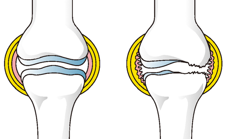 健康な膝関節と痛んだ膝関節