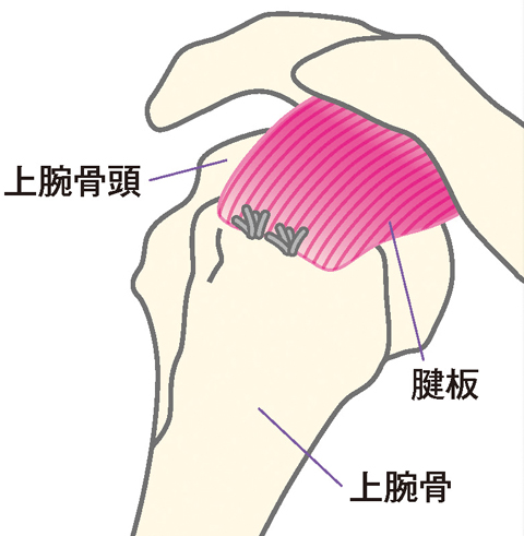 切れた腱板と骨を縫合