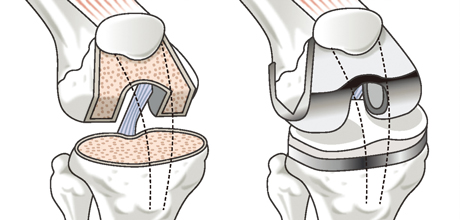 人工膝関節置換術