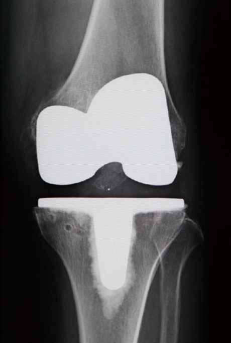 人工膝関節置換術後のレントゲン