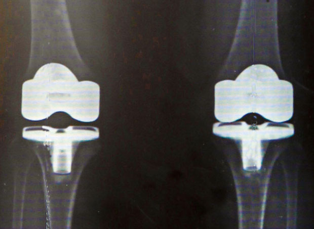 人工膝関節全置換術後のレントゲン（両脚）