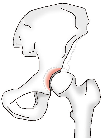 骨臼形成不全の股関節